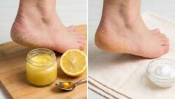 Quick Healing Method for Dry Cracked Heels Using Simple Kitchen Ingredients